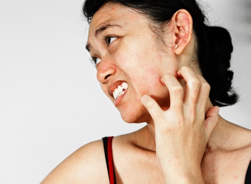 woman with allergic contact dermatitis